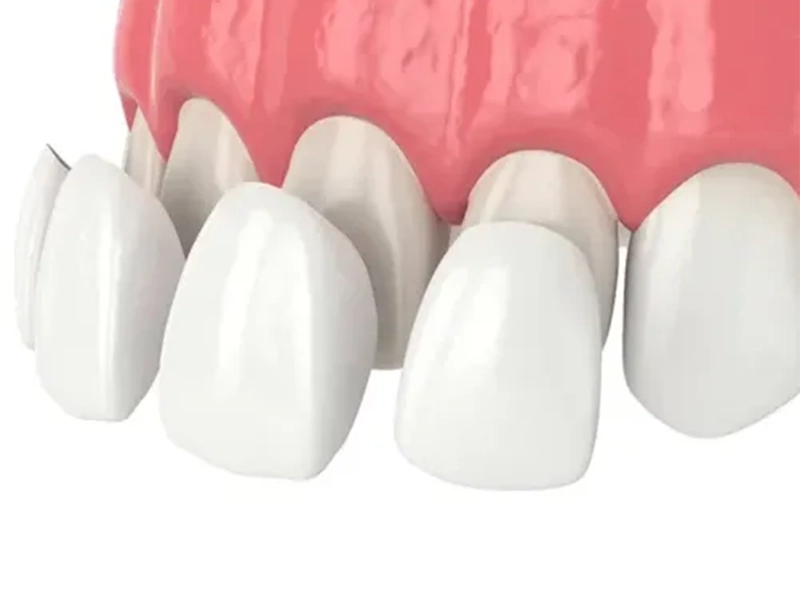 leeming-dental-veneers-01 Veneers