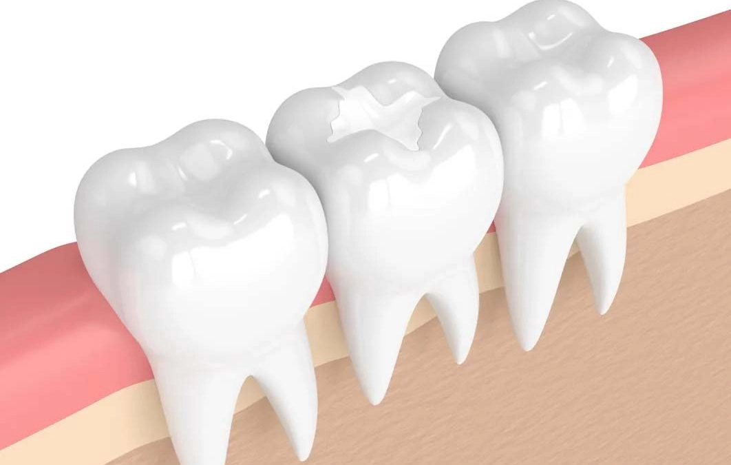 White dental fillings – CEREC porcelain vs composite resin