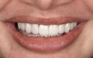 Veneers