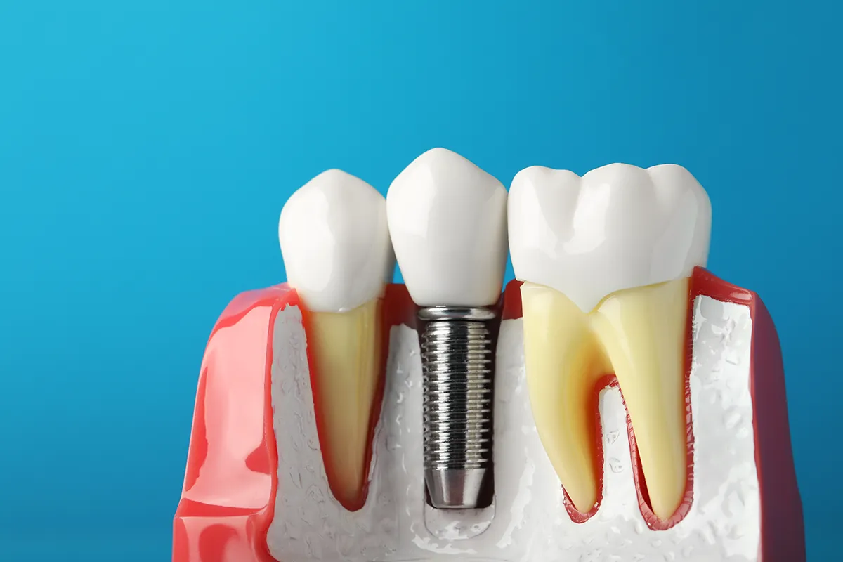 Dental Implants Dental Implants