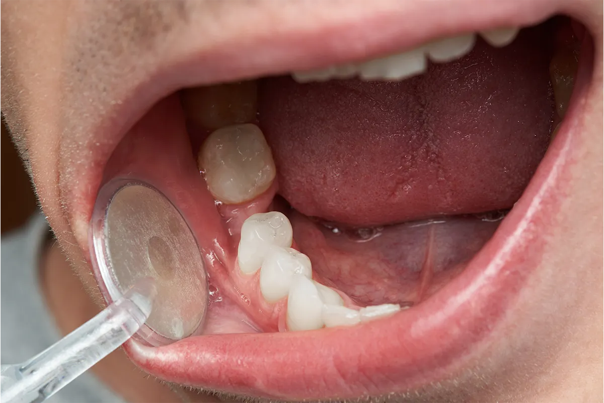 Leeming-Dental-missing-teeth Why you can't afford to ignore gaps in your smile