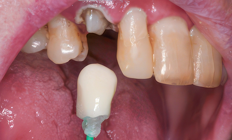 3D-printed crown before characterisation 3D-printed crown before characterisation
