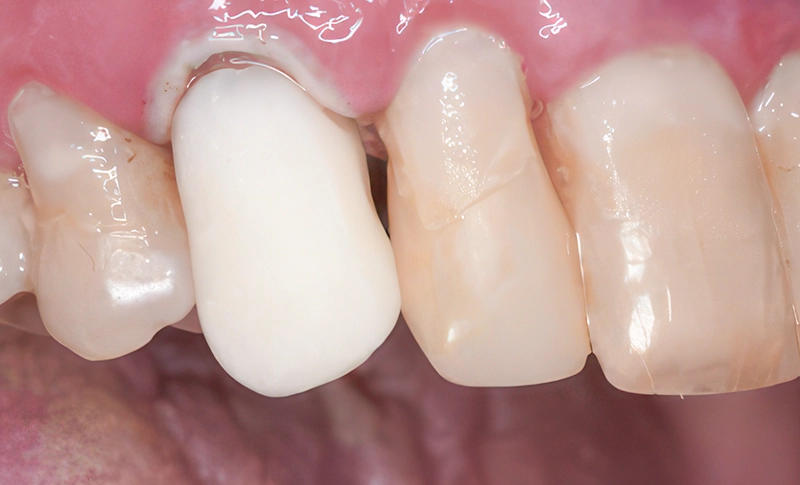 3D-printed crown before characterisation 3D-printed crown before characterisation