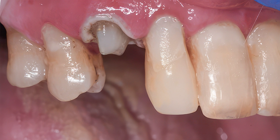 Patient Concern Case Study: Rebuilding a Decoronated Tooth