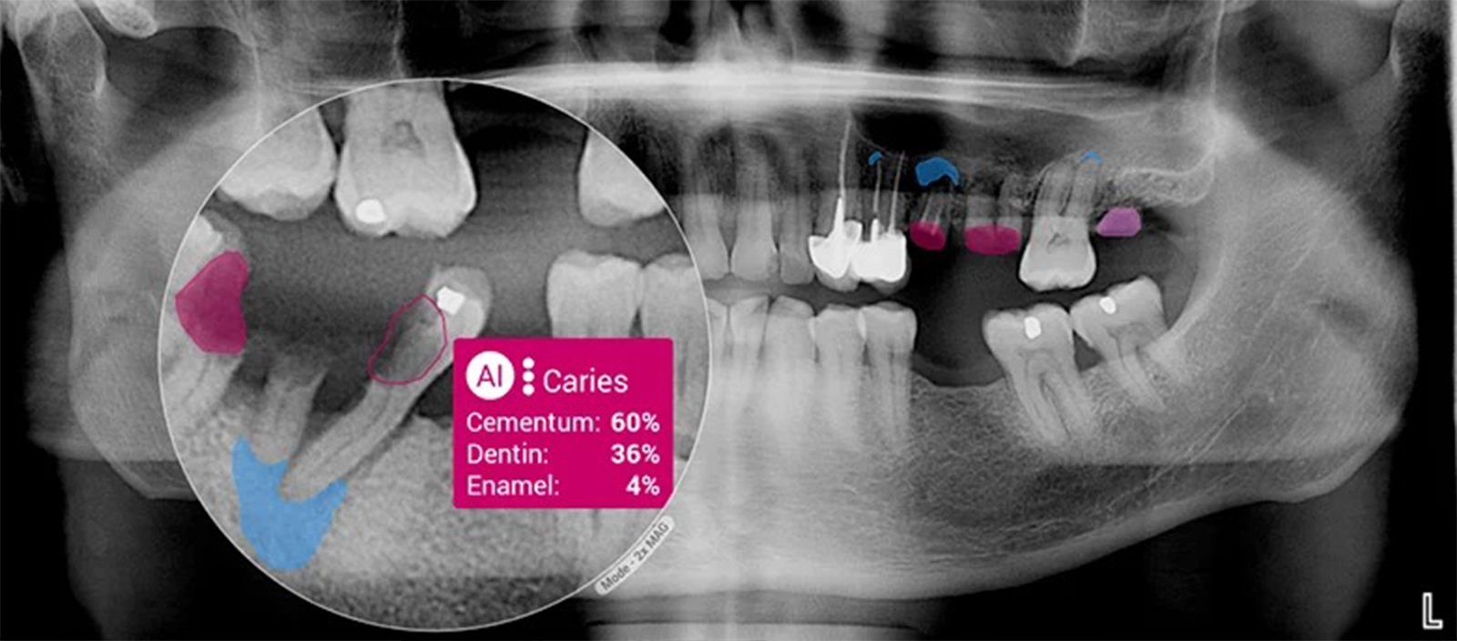 The future of artificial intelligence (AI) in dentistry